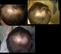 From left to right :
10years ago -About 1 year after it began. 8 months later it was 2x  bigger so I started on FIN 

Almost 3years ago-Using Minox only

Bottom pic1 month ago- went off Minox for about 3 months and then realized I needed to go back on.

So how would you rate my progression for 10 years-slow fast etc?
