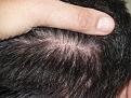 After FUE procedure