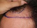 Before FUE procedure