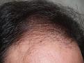 Before FUE procedure