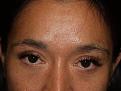 Before Eyebrow Transplant Procedure