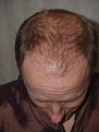 Before Hair Transplant Procedure