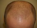 5 Days After Hair Transplant Procedure