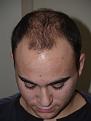 Before Hair Transplant Procedure