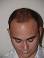 After Hair Transplant Procedure
