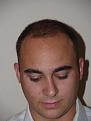 After Hair Transplant Procedure