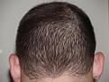 After Hair Transplant Procedure