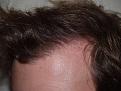 After Hair Transplant Procedure