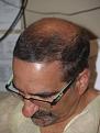 Before Hair Transplant