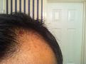 I always hated seeing this when I would walk into the bathroom. You can see how thinned out the scalp looks and how deep you can look into the area. This is my left side of the scalp.