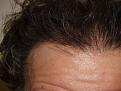 After Hair Transplant Procedure