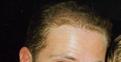 My Hair in 1996 just after my first surgery aged 23