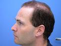 Left profile at least I had decent donor that got my 4856 grafts with Dr Hasson