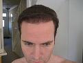 Photos taken in 2011
All photos 5 years on from H&W surgery in 2006
1 year from hairline refinement on 2010