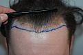 Hairline with surgical hairline design