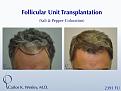 This patient is seen Before/After a 2391 graft
session with Carlos K. Wesley, M.D.

An interactive Before/After image of this patient can be viewed here:
www.drcarloswesley.com/frontal_08.html

A video of this patient's experience can be viewed here:
www.drcarloswesley.com/videos_09.html