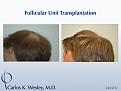 This 22-year-old can be seen before/after a 2265 grafts session to his mid scalp with Dr. Carlos K. Wesley

An interactive before/after image of this patient can be viewed at:
www.drcarloswesley.com/midscalp_03.html