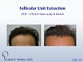 This patient had 1283 FUE grafts from beard and scalp with Dr. Carlos K. Wesley in NYC.  

An interactive before/after image can be viewed here:
www.drcarloswesley.com/improve_density04.html

A video of this patient's experience can be viewed here:
www.drcarloswesley.com/videos_08.html