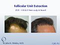 This patient had 1283 FUE grafts from beard and scalp with Dr. Carlos K. Wesley in NYC.  

An interactive before/after image can be viewed here:
www.drcarloswesley.com/improve_density04.html

A video of this patient's experience can be viewed here:
www.drcarloswesley.com/videos_08.html