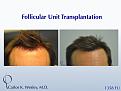 Before/After 1358 grafts to hairline and part line with Dr. Wesley in NYC.

The softening of the hairline can be accomplished with relatively few grafts.