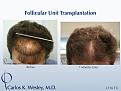 A 2116 graft session in Dr. Wesley practice in NYC. 
Wavy brown hair provides some of the best hair characteristics for more scalp coverage.