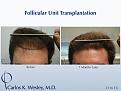 A 2116 graft session in Dr. Wesley practice in NYC. 
Wavy brown hair provides some of the best hair characteristics for more scalp coverage.