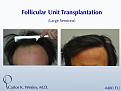 This 43-year-old man desired to reverse the progressive recession of his hairline. A total of 4480 grafts were transplanted to the frontal half of his scalp in order to create a natural-appearing hairline with considerable fullness.

A video of this patient's experience can be viewed here:
www.drcarloswesley.com/videos_17.html