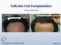 This 43-year-old man desired to reverse the progressive recession of his hairline. A total of 4480 grafts were transplanted to the frontal half of his scalp in order to create a natural-appearing hairline with considerable fullness.

A video of this patient's experience can be viewed here:
www.drcarloswesley.com/videos_17.html