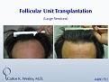 This 43-year-old man desired to reverse the progressive recession of his hairline. A total of 4480 grafts were transplanted to the frontal half of his scalp in order to create a natural-appearing hairline with considerable fullness.

A video of this patient's experience can be viewed here:
www.drcarloswesley.com/videos_17.html
