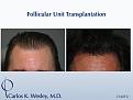 Before/After 2160 grafts
Dr. Carlos K. Wesley in New York City