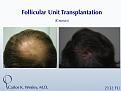 An interactive before/after image of this patient can be viewed at: 
www.drcarloswesley.com/Crown_01.html

While much can be achieved when treating the vertex (crown) in a single session, this region may require more than one session to fully appreciate optimal coverage. Because of his above-average donor density as well as his ideal hair characteristics, this 46-yr-old man did obtain tremendous coverage with a single 2132-micrograft session to the crown.