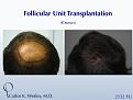 An interactive before/after image of this patient can be viewed at: 
www.drcarloswesley.com/Crown_01.html

While much can be achieved when treating the vertex (crown) in a single session, this region may require more than one session to fully appreciate optimal coverage. Because of his above-average donor density as well as his ideal hair characteristics, this 46-yr-old man did obtain tremendous coverage with a single 2132-micrograft session to the crown.