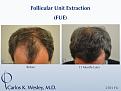 Follicular Unit Extraction (FUE) with Dr. Carlos K. Wesley in New York City.  Before/After 2701 FUE grafts using a combination of 0.8mm and 0.9mm motorized punches.

The first postoperative week of this patient's experience with Dr. Wesley can be viewed here:
www.drcarloswesley.com/videos_11.html