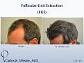 Follicular Unit Extraction (FUE) with Dr. Carlos K. Wesley in New York City.  Before/After 2701 FUE grafts using a combination of 0.8mm and 0.9mm motorized punches.

The first postoperative week of this patient's experience with Dr. Wesley can be viewed here:
www.drcarloswesley.com/videos_11.html