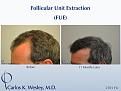 Follicular Unit Extraction (FUE) with Dr. Carlos K. Wesley in New York City.  Before/After 2701 FUE grafts using a combination of 0.8mm and 0.9mm motorized punches.

The first postoperative week of this patient's experience with Dr. Wesley can be viewed here:
www.drcarloswesley.com/videos_11.html