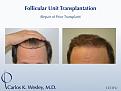 Before/After 1251 grafts
Dr. Wesley repairs a hairline initially transplanted by a different surgeon.  The patient's wide donor scar was also minimized by Dr. Wesley during the repair session.

An interactive before/after of this patient's results can be viewed at:
www.drcarloswesley.com/conceal_scarring01.html