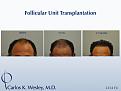 A patient as seen at different stages post transplant from Dr. Carlos K. Wesley