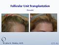 Before/After of a female patient undergoing a 1573 graft session with the NYC practice of Dr. Carlos K. Wesley.

An interactive before/after image of this patient can also be seen at:
www.drcarloswesley.com/temporal_recessions.html