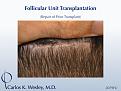 Softening a "pluggy" appearing hairline can be achieved in a single session. This 42-year-old male had previously undergone two hair transplants that left him with an unnatural appearing hairline. Dr. Wesley effectively softened his hairline and, after only seven months, the patient was already beginning to benefit from this repair session consisting of 2079 micro grafts.

An interactive before/after image of this patient can be viewed here:
www.drcarloswesley.com/soften_a_pluggy_appearance.htm