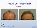 Before/After a treatment with 3976 grafts by Dr. Carlos K. Wesley in New York City.

A video of this patient's transformation may be viewed here:
https://vimeo.com/68079586