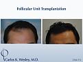 This patient presented at age 30 with coarse straight black hair that had progressively receded throughout his frontal third. A session involving 2566 micrografts throughout the frontal region of his scalp provided considerable coverage to the area that bothered him most.

An interactive before/after image of this patient may be seen here:
www.drcarloswesley.com/frontal_03.html

A video of this patient's experience with Dr. Wesley may be viewed here:
www.drcarloswesley.com/videos_19.html