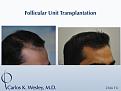 This patient presented at age 30 with coarse straight black hair that had progressively receded throughout his frontal third. A session involving 2566 micrografts throughout the frontal region of his scalp provided considerable coverage to the area that bothered him most.

An interactive before/after image of this patient may be seen here:
www.drcarloswesley.com/frontal_03.html

A video of this patient's experience with Dr. Wesley may be viewed here:
www.drcarloswesley.com/videos_19.html