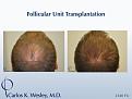 This 25-year-old patient had tried finasteride 1mg (Propecia) prior to his decision to treat his thinning mid scalp with surgical hair restoration. He stopped Propecia months before his session and has not taken it since.

An interactive before/after image of this patient can be viewed here:
www.drcarloswesley.com/midscalp_05.html

A video of this patient's experience with Dr. Wesley can be viewed here:
www.drcarloswesley.com/videos_18.html