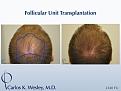An outline of the mid scalp region treated.

An interactive before/after image of this patient can be viewed here:
www.drcarloswesley.com/midscalp_05.html

A video of this patient's experience with Dr. Wesley can be viewed here:
www.drcarloswesley.com/videos_18.html