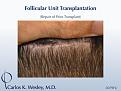 Donor scar after a 2079 micro graft repair session to soften the patient's "pluggy" hairline from a prior surgery with a different surgeon.

An interactive before/after image of this patient can be viewed here:
www.drcarloswesley.com/soften_a_pluggy_appearance.html

A video of this patient's experience can also be seen here:
www.drcarloswesley.com/videos_14.html