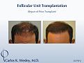 Softening a "pluggy" appearing hairline can be achieved in a single session. This 42-year-old male had previously undergone two hair transplants that left him with an unnatural appearing hairline. Dr. Wesley effectively softened his hairline and, after only seven months, the patient was already beginning to benefit from this repair session consisting of 2079 micro grafts.

An interactive before/after image of this patient can be viewed here:
www.drcarloswesley.com/soften_a_pluggy_appearance.htm