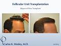 Softening a "pluggy" appearing hairline can be achieved in a single session. This 42-year-old male had previously undergone two hair transplants that left him with an unnatural appearing hairline. Dr. Wesley effectively softened his hairline and, after only seven months, the patient was already beginning to benefit from this repair session consisting of 2079 micro grafts.

An interactive before/after image of this patient can be viewed here:
www.drcarloswesley.com/soften_a_pluggy_appearance.htm