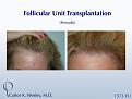 Before/After of a female patient undergoing a 1573 graft session with the NYC practice of Dr. Carlos K. Wesley.

An interactive before/after image of this patient can also be seen at:
www.drcarloswesley.com/temporal_recessions.html