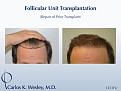 Before/After 1251 grafts
Dr. Wesley repairs a hairline initially transplanted by a different surgeon. The patient's wide donor scar was also minimized by Dr. Wesley during the repair session.

An interactive before/after of this patient's results can be viewed at:
www.drcarloswesley.com/conceal_scarring01.html