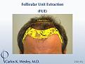 An illustration of the approach used by Dr. Carlos K. Wesley during this patient's two-day FUE session.

The first postoperative week of this patient's experience with Dr. Wesley can be viewed here:
www.drcarloswesley.com/videos_11.html